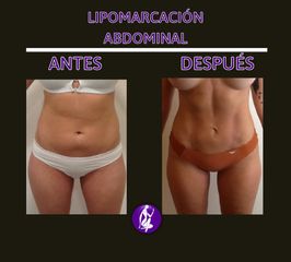 Liposucción - Centro Cince