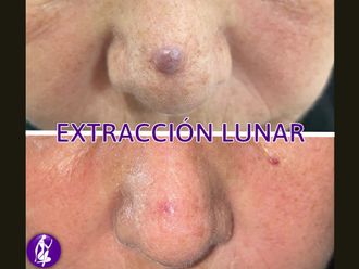 Lunares antes y después - 848980