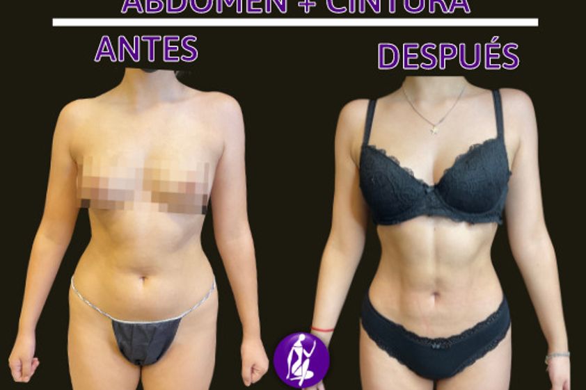 Liposucción antes y después - 848981