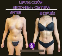 Liposucción - Centro Cince