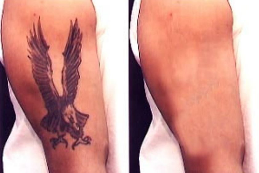 Borrar tatuajes antes y después - 501515