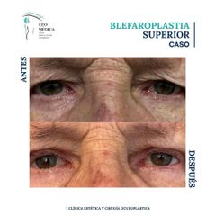 Blefaroplastia - Ceomédica