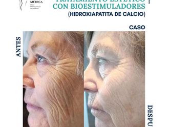 Rejuvenecimiento facial antes y después - 870011