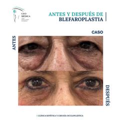 Blefaroplastia - Ceomédica