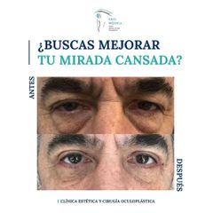 Blefaroplastia inferior - Ceomédica