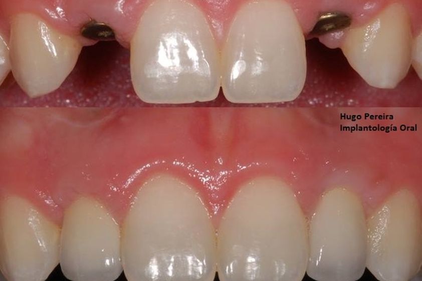 Implantes dentales antes y después - 573075