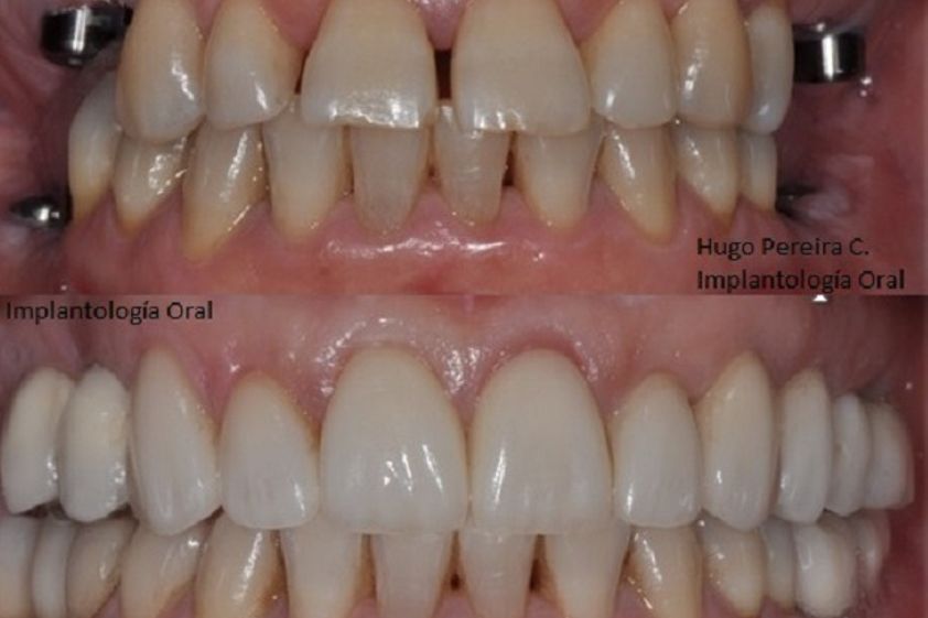 Implantes dentales antes y después - 573077
