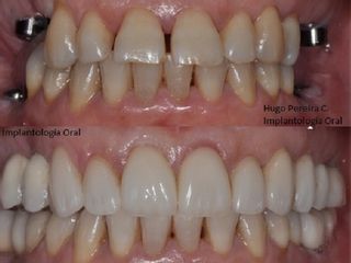implantologia oral 2