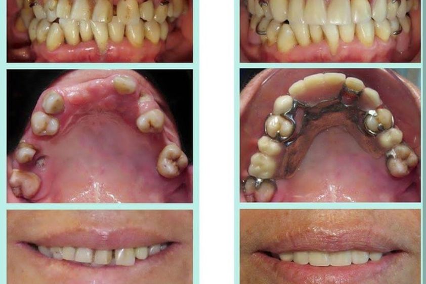 Prótesis dentales antes y después - 612439