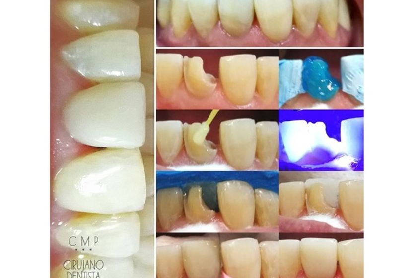 Endodoncia antes y después - 621550
