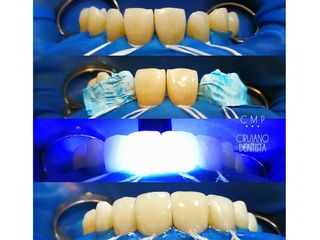 Carillas de composite directa sin desgaste dentario previo