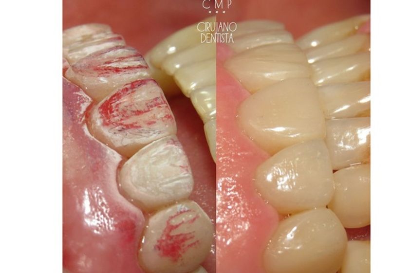 Endodoncia antes y después - 621553