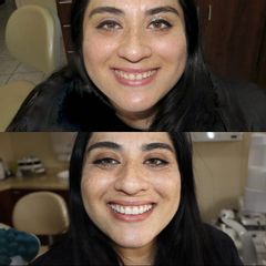 Blanqueamiento dental - Dra. Claudia Mora Pérez