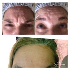 Rejuvenecimiento Facial con Bótox