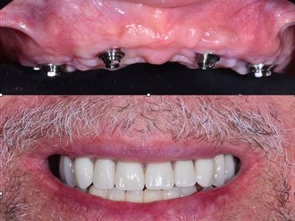 Implantes dentales - 850173