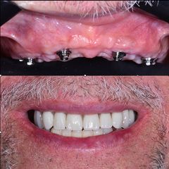Implantes dentales - Dr. Carlos Cartes Aedo