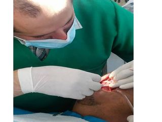 Implantes dentales