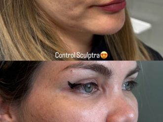 Rejuvenecimiento facial antes y después - 871359