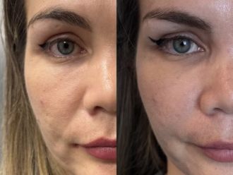 Rejuvenecimiento facial antes y después - 871360