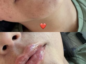 Aumento de labios antes y después - 871362