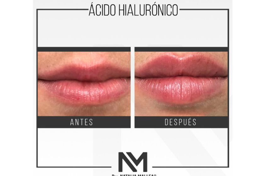 Aumento de labios antes y después - 642718