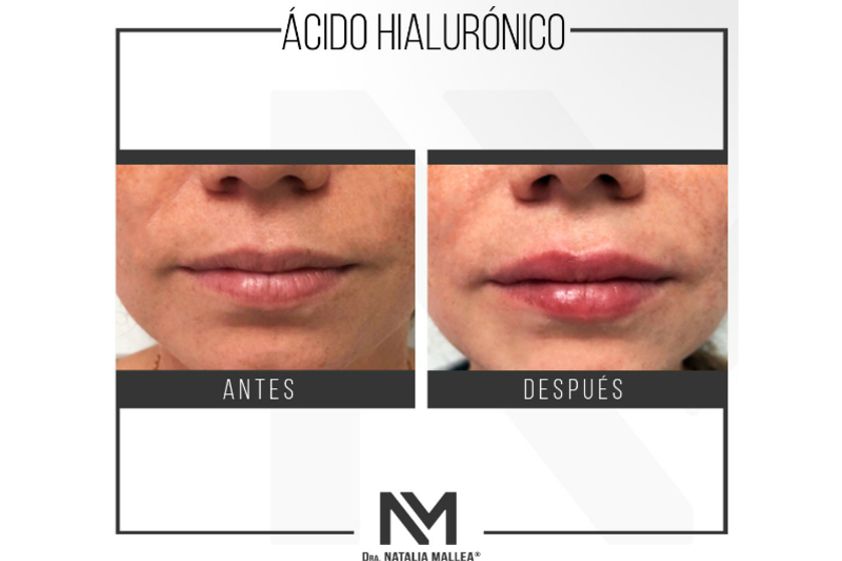 Ácido hialurónico antes y después - 642720