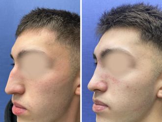 Rinoplastía antes y después - 859829