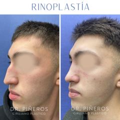 Rinoplastia - Dr. José Luis Piñeros Barragán