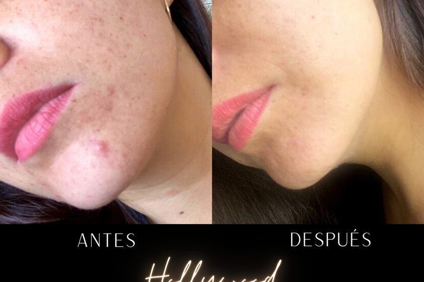 Peeling antes y después - 859830