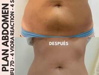 HIFU antes y después - 861377
