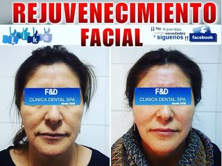 REJUVENECIMIENTO FACIAL 