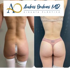 Aumento de glúteos - Dr. Andrés Ordenes Evensen