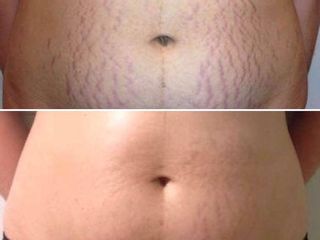 Tratamiento con Carboxiterapia y Plasma rico en plaquetas (PRP) 