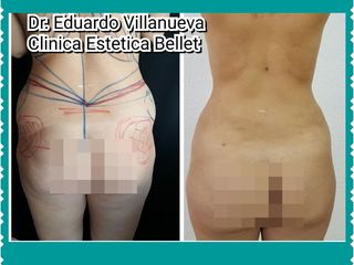LIPOESCULTURA VASER
