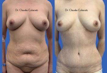 Abdominoplastia - Dr. Claudio Culaciati Tapia