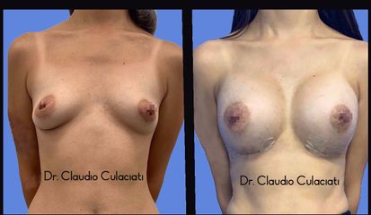 Aumento mamario - Dr. Claudio Culaciati Tapia