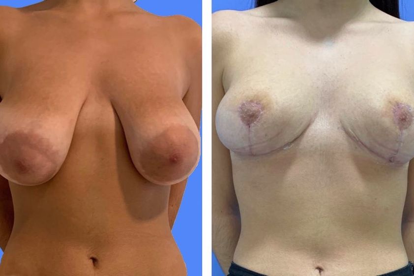 Mastopexia antes y después - 684782