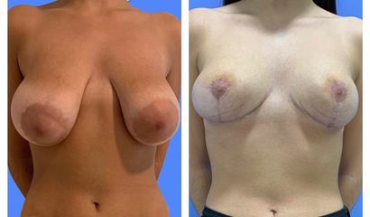 Mastopexia - Dr. Claudio Culaciati Tapia