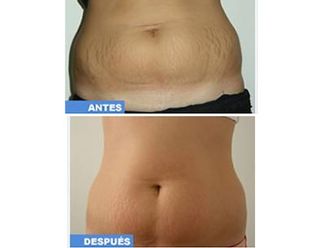 Eliminar las estrías antes y después - 487149