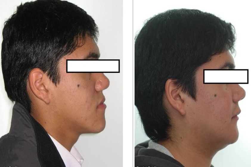 Ortodoncia antes y después - 433094