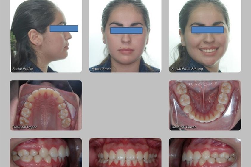 Ortodoncia antes y después - 433396