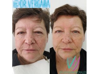 Rejuvenecimiento facial