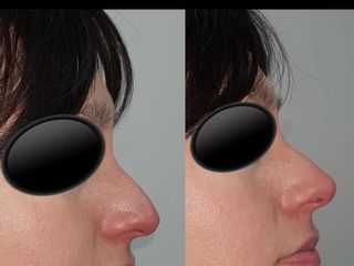 Rinomodelación, modificar la nariz sin pasar por el quirófano