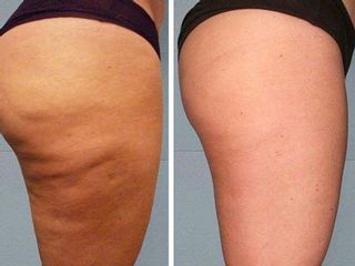 TRATAMIENTO CELULITIS