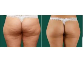celulitis