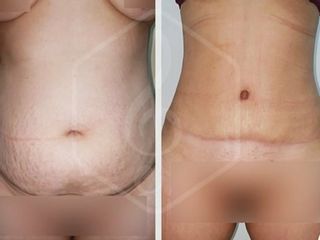 Abdominoplastia