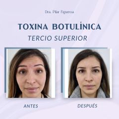 Toxina botulínica - Dra. Natali del Pilar Figueroa Rosero