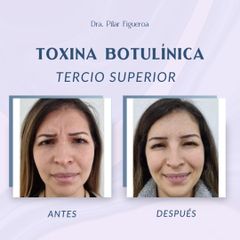 Toxina botulínica - Dra. Natali del Pilar Figueroa Rosero