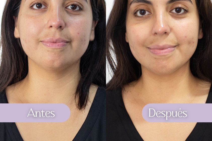 HIFU antes y después - 863556
