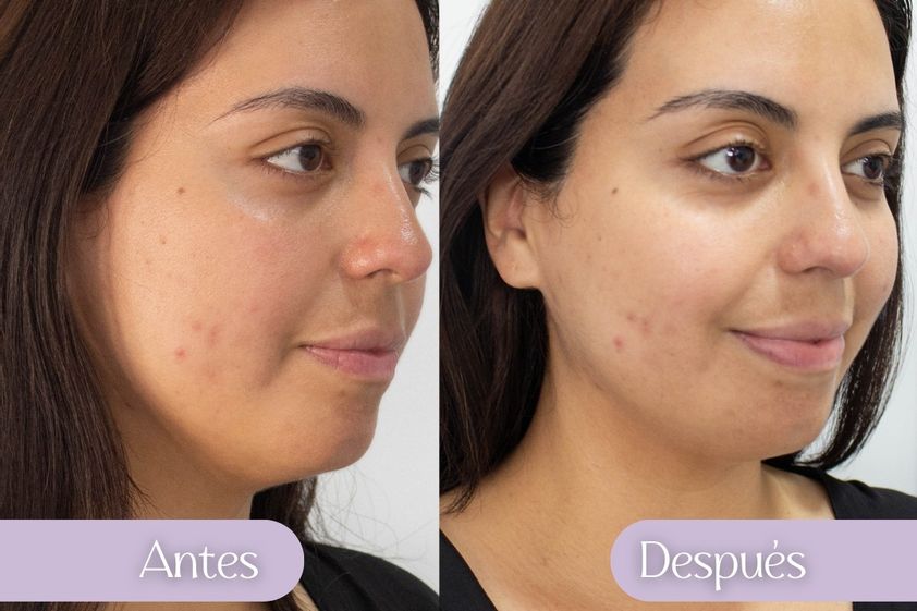 HIFU antes y después - 863557
